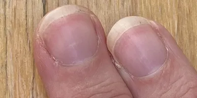 Лечение пустоты под ногтем - онихолизиса: что делать с пустотами под ногтем  на пальцах ног и рук