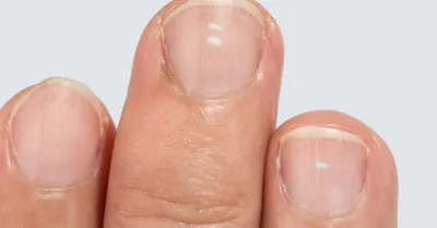Белые пятна на ногтях: что они могут значить?