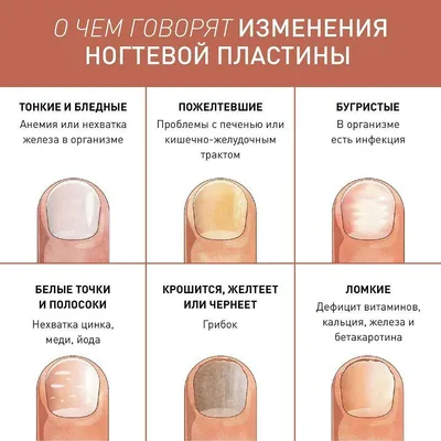 Белые точки на ногтях: причины и методы лечения | theGirl