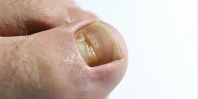 Причины появления желтых ногтей на ногах и способы их устранения
