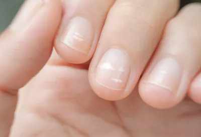 Белые пятна на ногтях: лечение, причины и диагностика пятен
