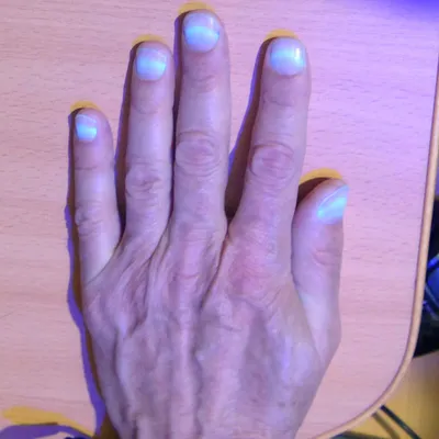 Онихолизис ногтей: симптомы, лечение отслоения ногтя, ногтевой пластины —  причины - 23 марта 2023 - Sport24