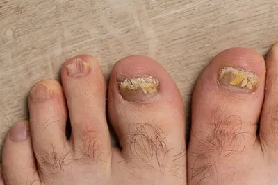 Спроси у доктора: что означают белые пятна на ногтях?