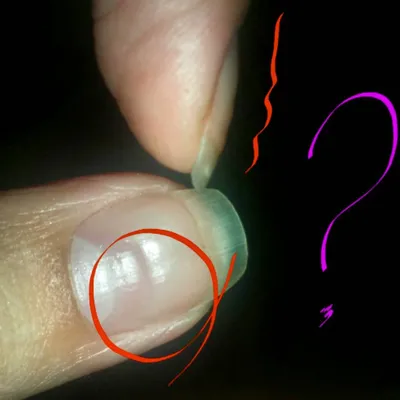 Кандидоз ногтей: лечение, причины, симптомы и диагностика грибка кандида на  ногтях