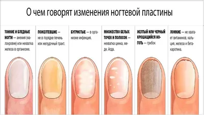 Изменения ногтей - зеркало вашего здоровья | PROsimptom | Дзен