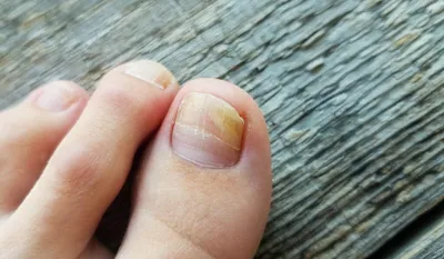 Белые пятна на ногтях ног фото фото