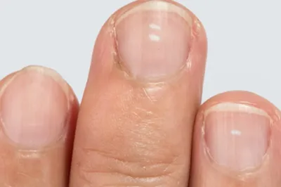 Маленькие белые пятна на ногтях: что это такое?