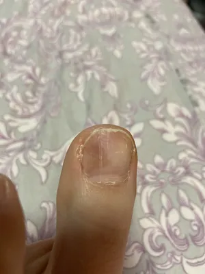 Белые полоски на ногтях рук – причины, что означают | Лечение белых  продольных / поперечных полос в Клинике подологии Полёт