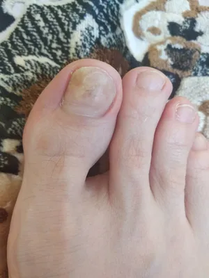 Коричневые пятна на ногтях больших пальцев ног Сегодня обнаружила такую |  MedAboutMe