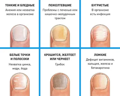 Синегнойная палочка на ногтях - симптомы и лечение