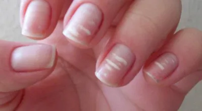 Желтые пятна на ногтях рук – основные причины и методы лечения