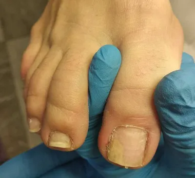 Белые пятна на ногтях: что они могут значить?