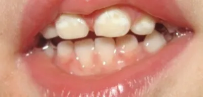 Белые пятна на зубах у ребенка: почему появляются и как убрать