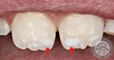Белые Пятна На 32 Зубах У Ребенка Взрослого ЛюмиДент