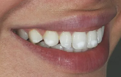 Белые пятна на зубах – Причины, лечение и профилактика