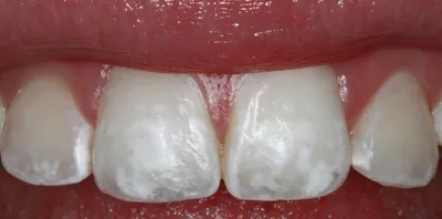 Белые пятна на зубах у ребенка – Причины появления и методы лечения