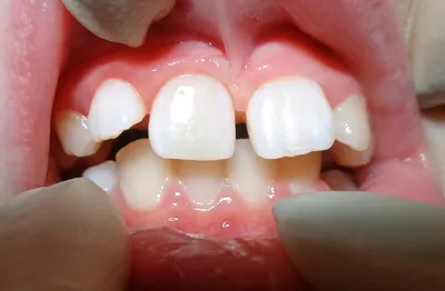 Опасны ли белые пятна на зубах?