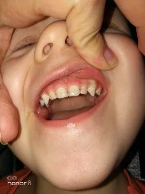 Белые пятна на молочных зубах у грудного ребенка – почему у годовалых детей  и грудничков появились точки на эмали постоянных коренных передних резцов