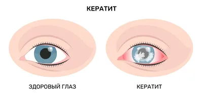 О чем говорит белое пятно в глазу - Новости здоровья - Здоровье 24