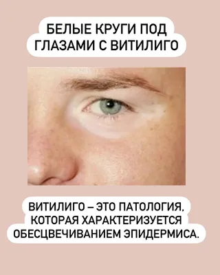 Белые пятна на носу и под глазами. Что это? | Prokoni.ru