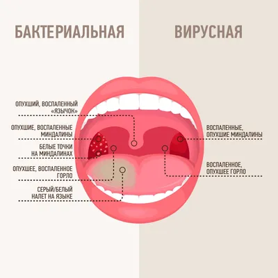 Ангина - признаки, симптомы, диагностика и лечение | острый тонзиллит у  взрослых и детей