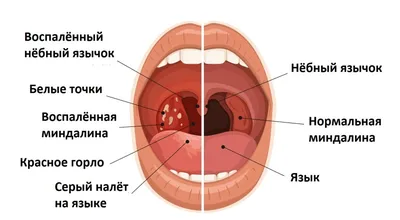 Симптомы тонзиллита / Статьи / Семейная клиника А-Медия