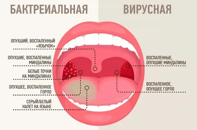 Сыпь На Корне Языка Прыщи Ближе к Горлу ЛюмиДент