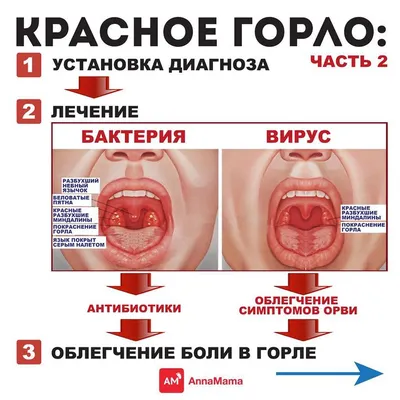 Тонзиллит - причины появления, симптомы заболевания, диагностика и способы  лечения