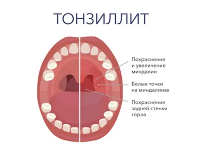 Почему появляются белые пятна во рту? 6 возможных причин | Стоматология  ROOTT | Дзен