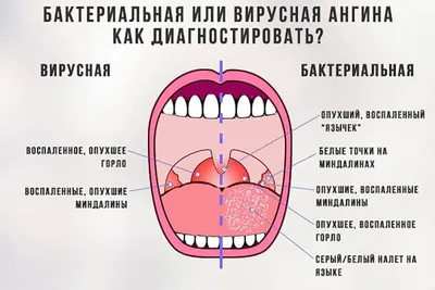 Белые пятна на горле - Вопрос лору - 03 Онлайн