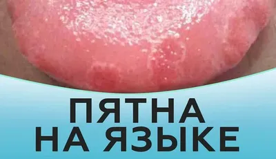 Британские медики рассказали об опасности пятен в ротовой полости /  VSE42.RU - информационный сайт Кузбасса.