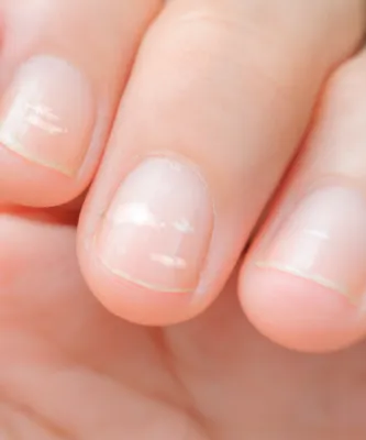 Белые точки и полоски на ногтях