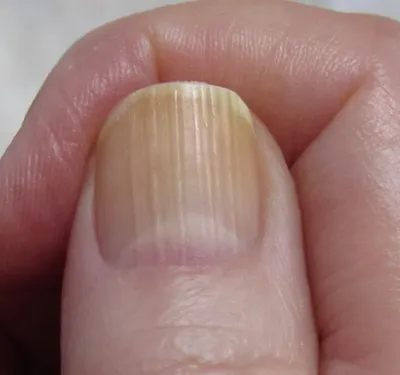 Белые полоски на ногтях рук (53 фото)