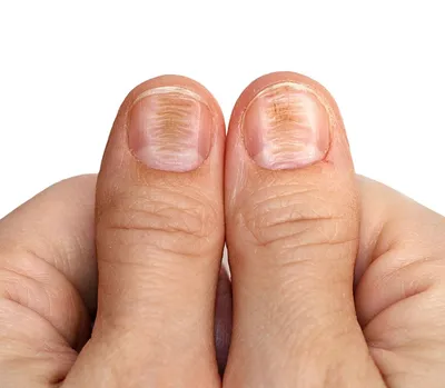 Дерматовенеролог Соколова назвала белые полоски на ногтях симптомом  туберкулеза - Газета.Ru | Новости