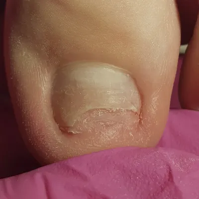 Коричневое пятно под ногтем на ноге (73 фото)