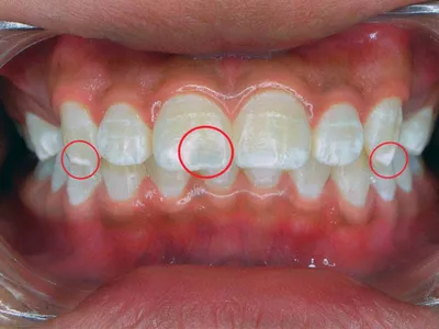 Белые пятна на зубах — причины появления, как убрать белые точки на зубах