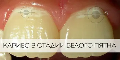 Белые точки на деснах — 3 ответов | форум Babyblog