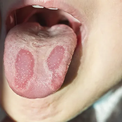 Красное горло с белыми точками у ребенка: причины и лечение