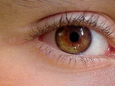 Красные глаза — причины покраснения, что делать, как лечить, профилактика