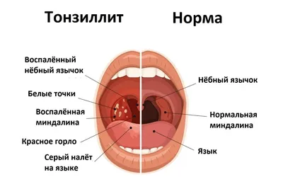 Пробки\" в миндалинах. Что делать?