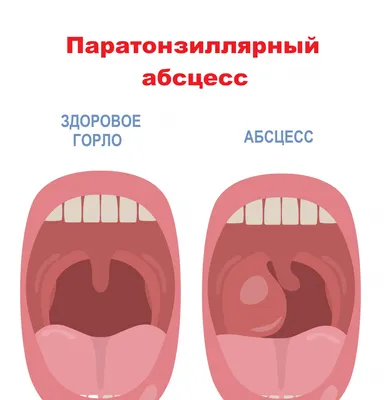 Лечение тонзиллита в Барнауле