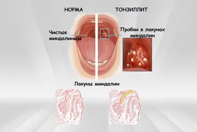 На миндалинах белый налет: чем лечить белые точки на гландах, причины  появления, диагностика, возможные осложнения