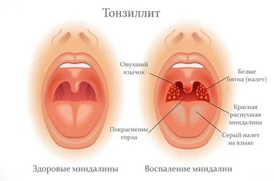 Хронический тонзиллит (ангина) | Реальный медик | Дзен