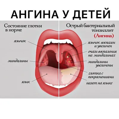 Доктор Тобиас - О чем говорит налет на миндалинах ⠀ Чаще всего детей  поражают вирусные инфекции. Они же являются лидерами по количеству  различных симптомов, включая белый налет на миндалинах. Белые точки, которые