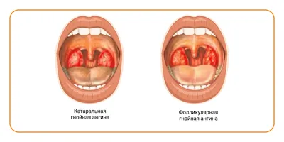 Сильный Белый Налет На Миндалинах – Telegraph