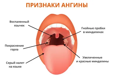 Кандидоз (молочница) полости рта у детей - справочник заболеваний Медюнион