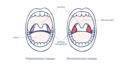 Отзыв о Тонзиллэктомия или удаление миндалин | Никаких гарантий