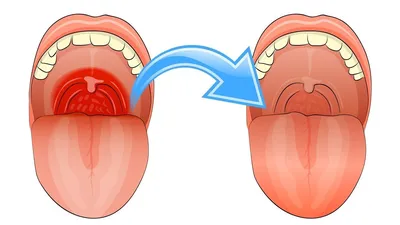 Как вылечить белый налет на миндалинах у ребенка?» — Яндекс Кью