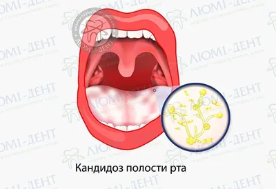 Помогите три месяца белый налёт на миндалинах - Вопрос лору - 03 Онлайн