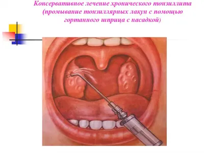 Фарингит | Симптомы, признаки, лечение воспаления глотки - Prodex